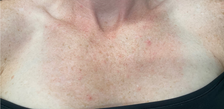 Laser Rejuvenation Before & After Image
