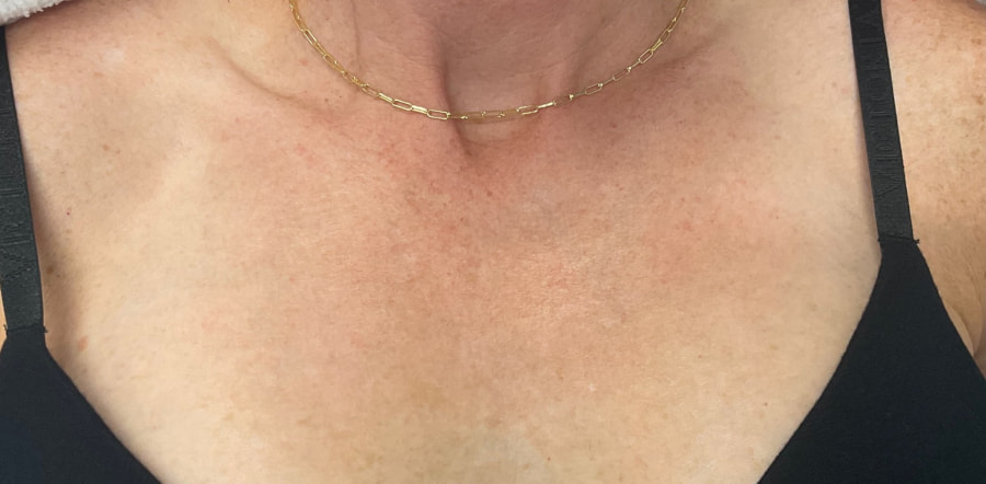 Laser Rejuvenation Before & After Image