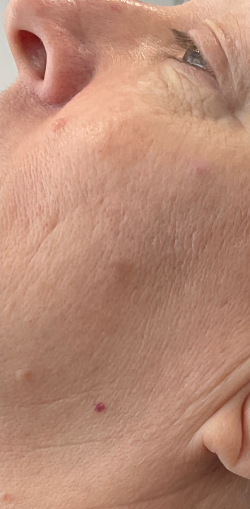 Laser Rejuvenation Before & After Image