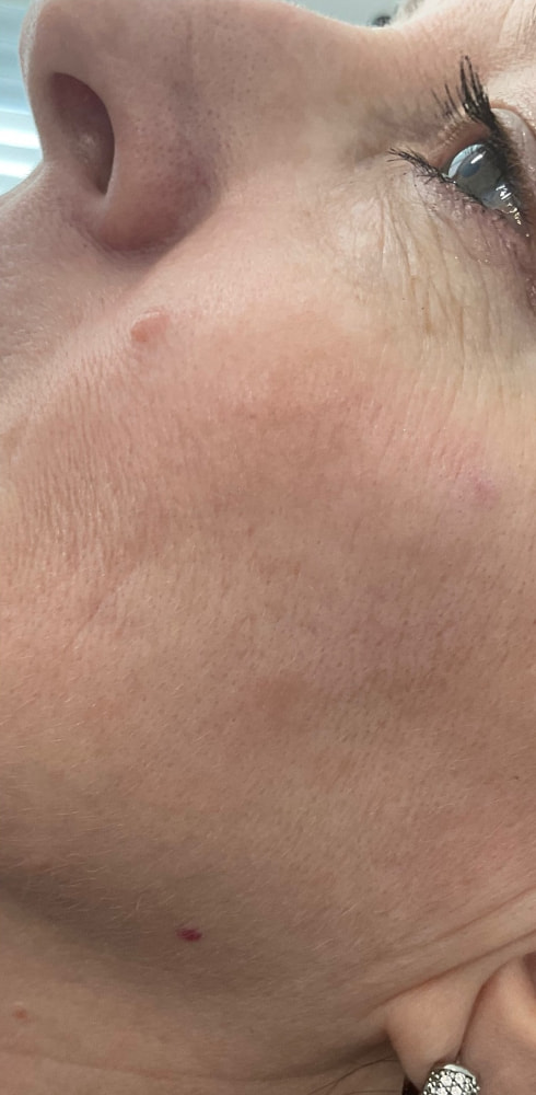 Laser Rejuvenation Before & After Image