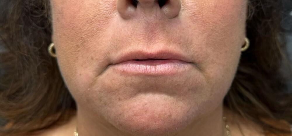 Lip Filler Before & After Image