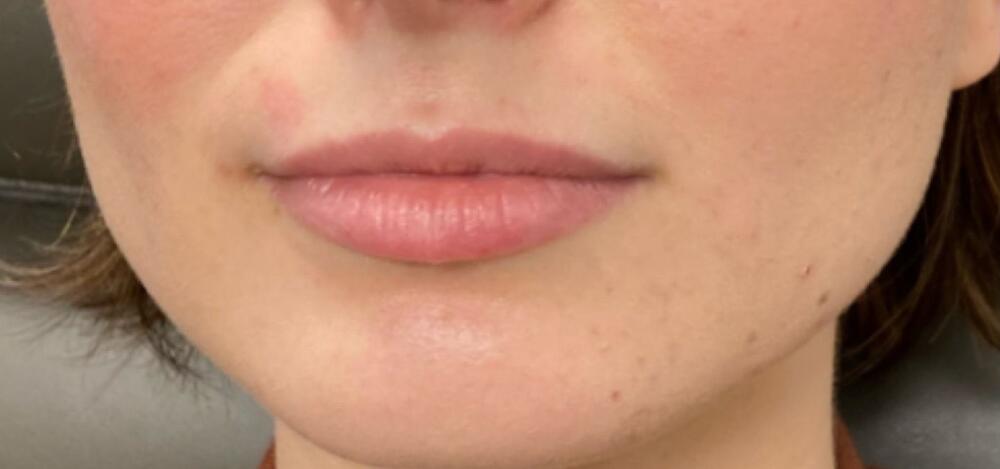 Lip Filler Before & After Image