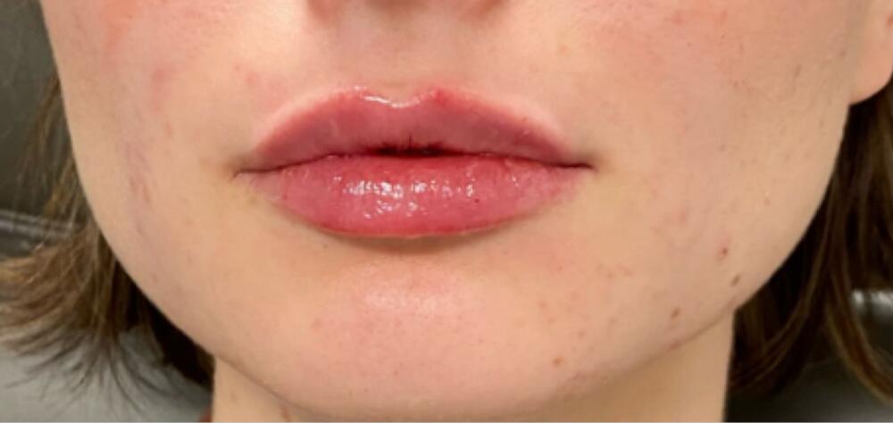 Lip Filler Before & After Image