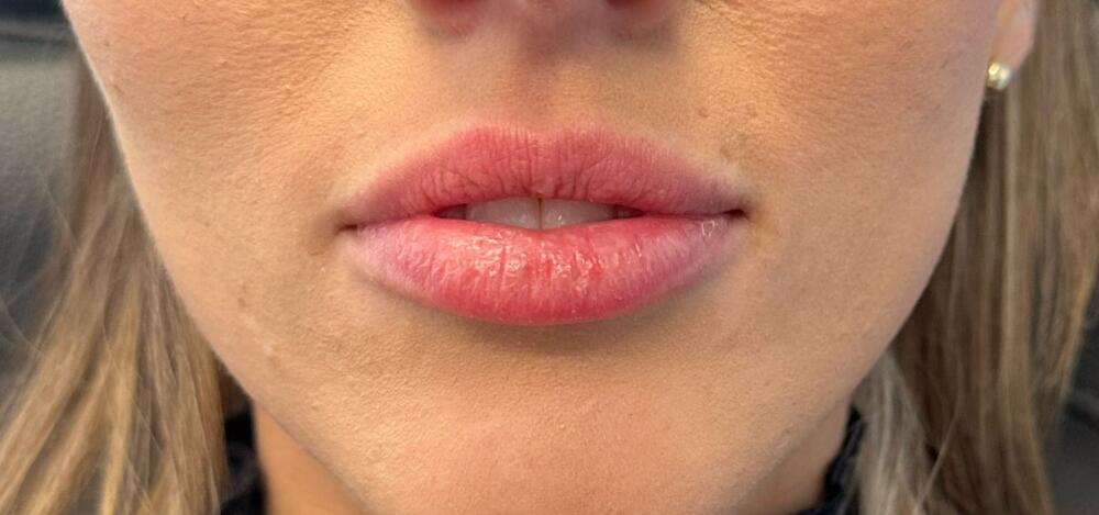 Lip Filler Before & After Image