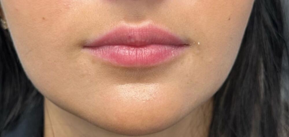 Lip Filler Before & After Image