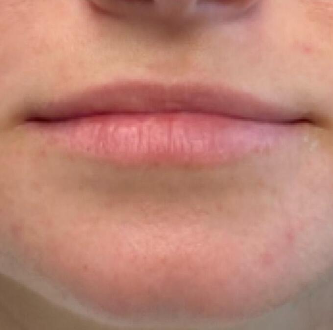 Lip Filler Before & After Image