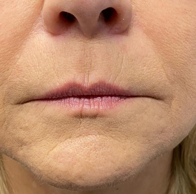 Lip Filler Before & After Image