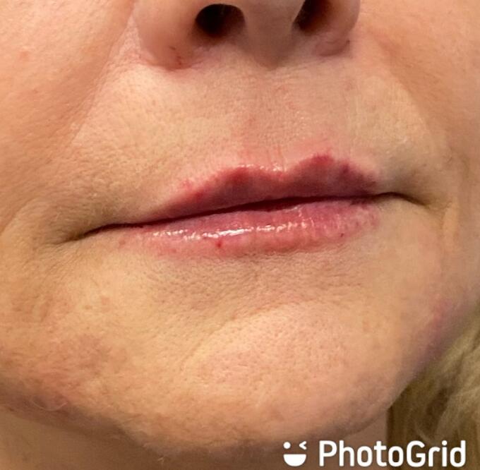 Lip Filler Before & After Image