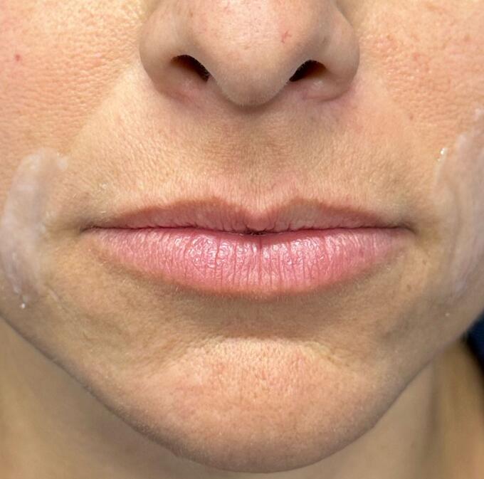 Lip Filler Before & After Image