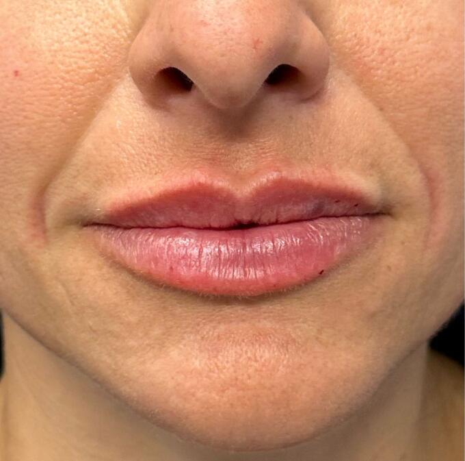 Lip Filler Before & After Image