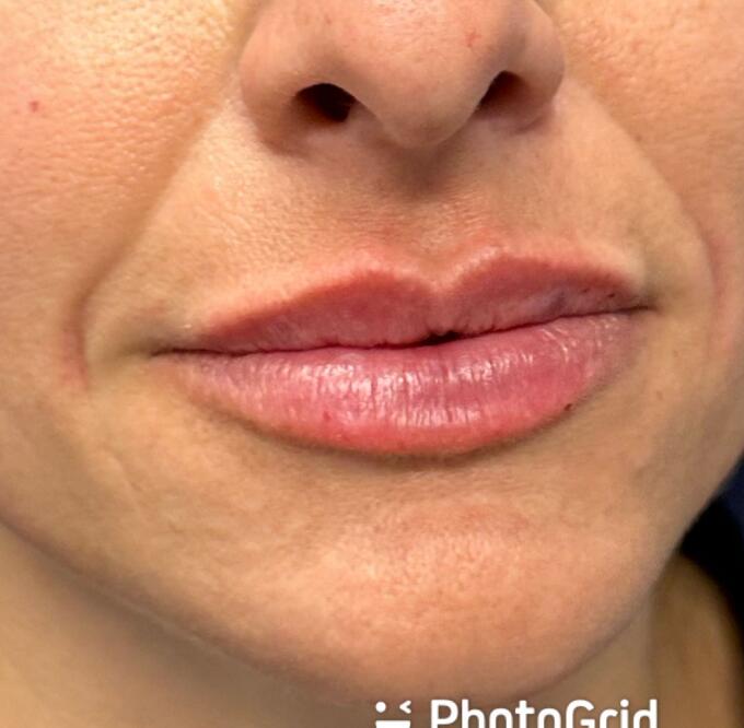 Lip Filler Before & After Image