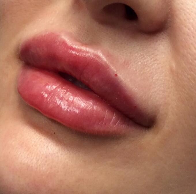 Lip Filler Before & After Image