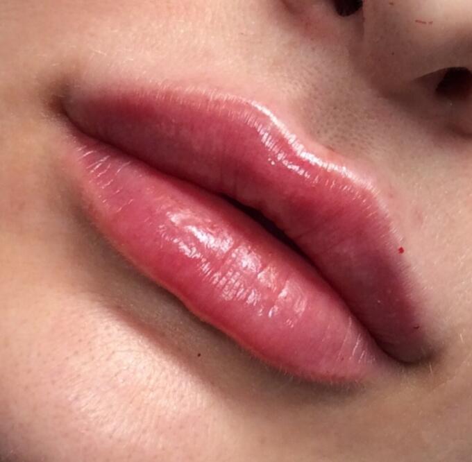 Lip Filler Before & After Image