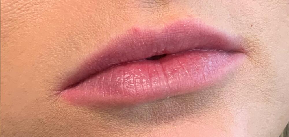 Lip Filler Before & After Image