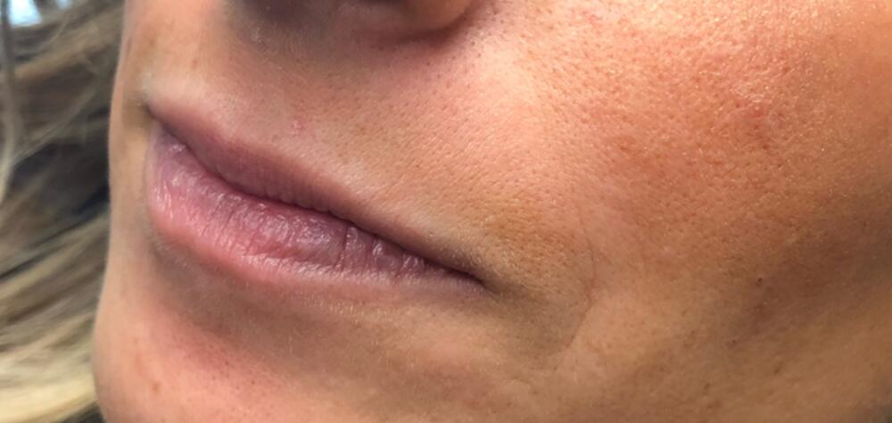 Lip Filler Before & After Image