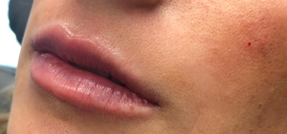 Lip Filler Before & After Image