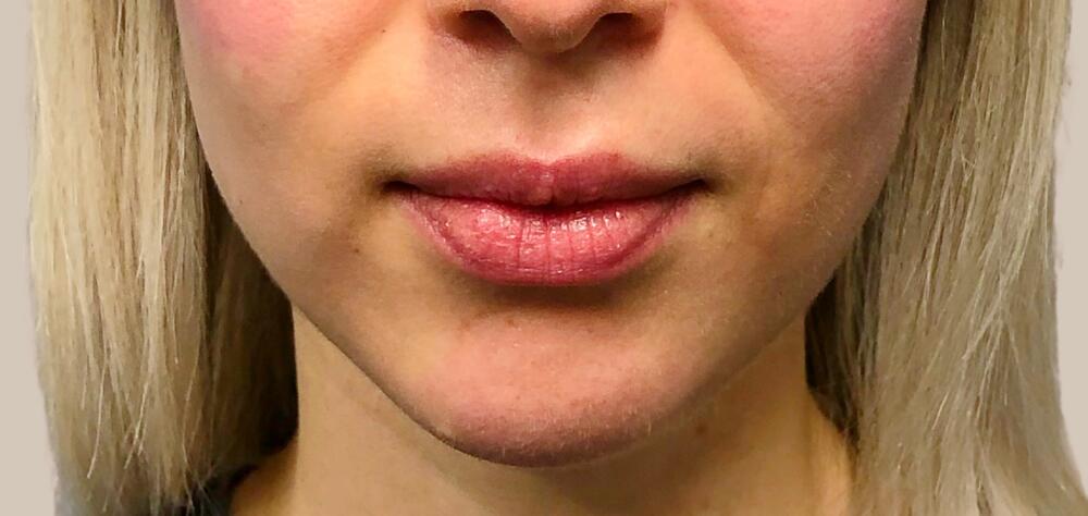 Lip Filler Before & After Image