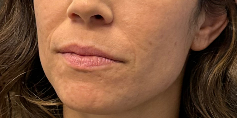 Lip Filler Before & After Image