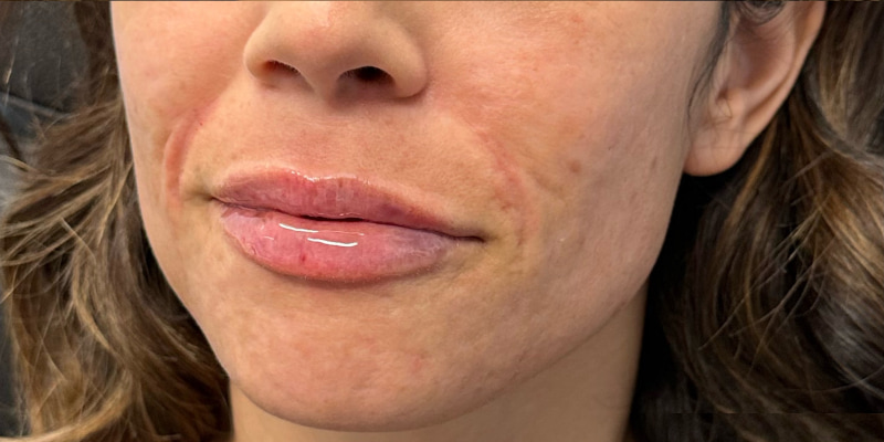 Lip Filler Before & After Image