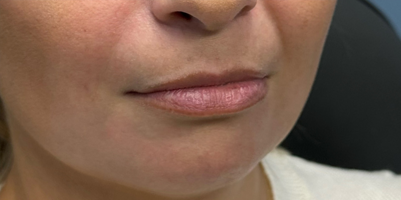 Lip Filler Before & After Image