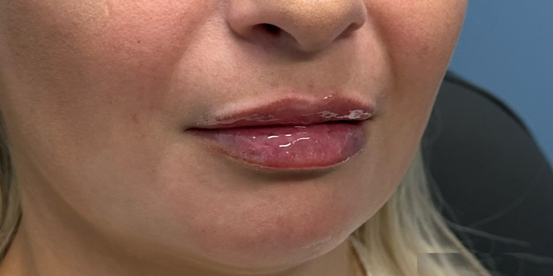 Lip Filler Before & After Image