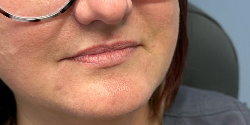 Lip Filler Before & After Image