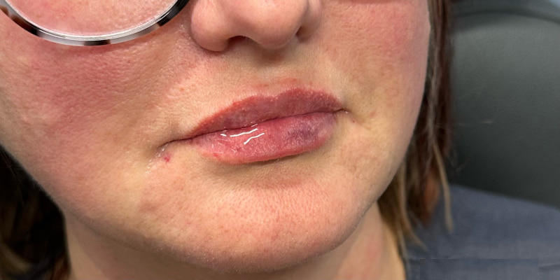 Lip Filler Before & After Image