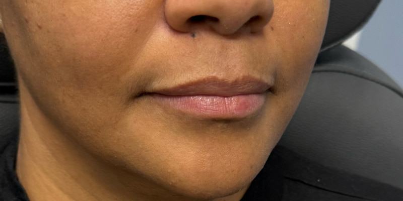 Lip Filler Before & After Image