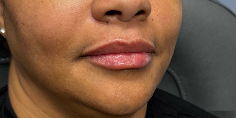 Lip Filler Before & After Image