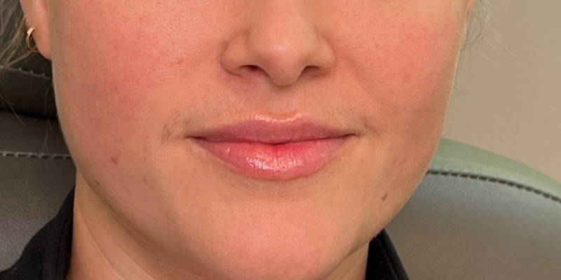Lip Filler Before & After Image