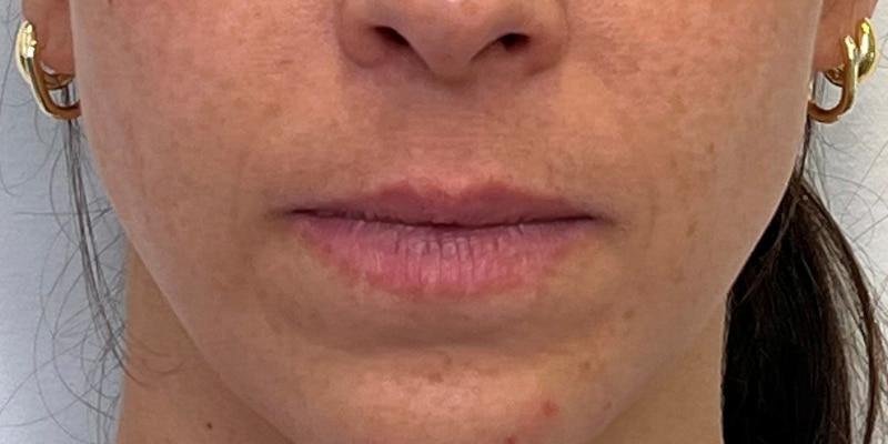 Lip Filler Before & After Image