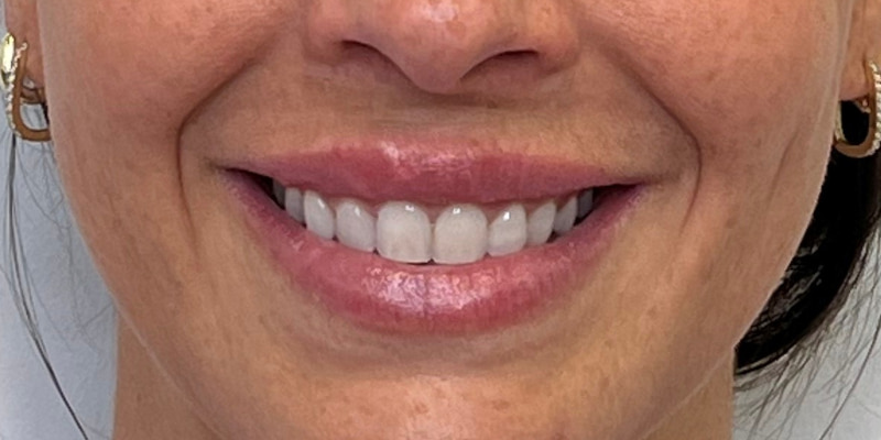 Lip Filler Before & After Image