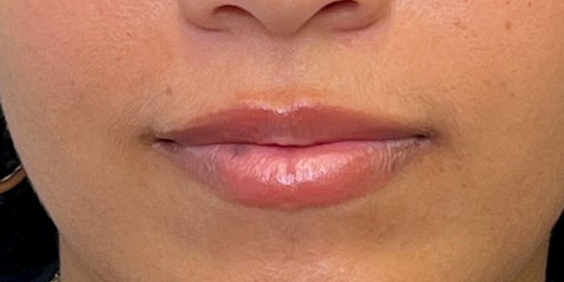 Lip Filler Before & After Image