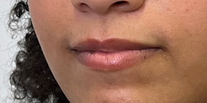 Lip Filler Before & After Image