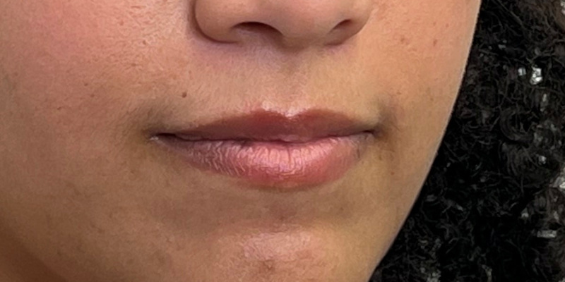 Lip Filler Before & After Image