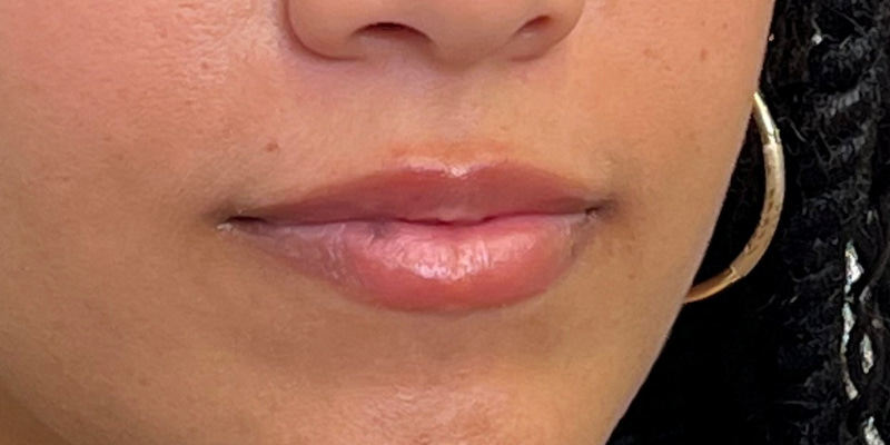Lip Filler Before & After Image