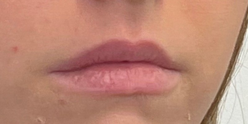 Lip Filler Before & After Image