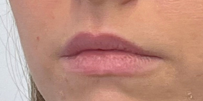 Lip Filler Before & After Image