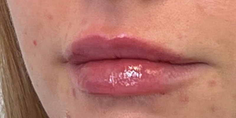 Lip Filler Before & After Image