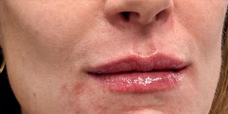 Lip Filler Before & After Image