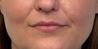 Lip Filler Before & After Image