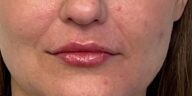 Lip Filler Before & After Image