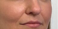 Lip Filler Before & After Image