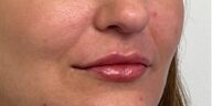 Lip Filler Before & After Image