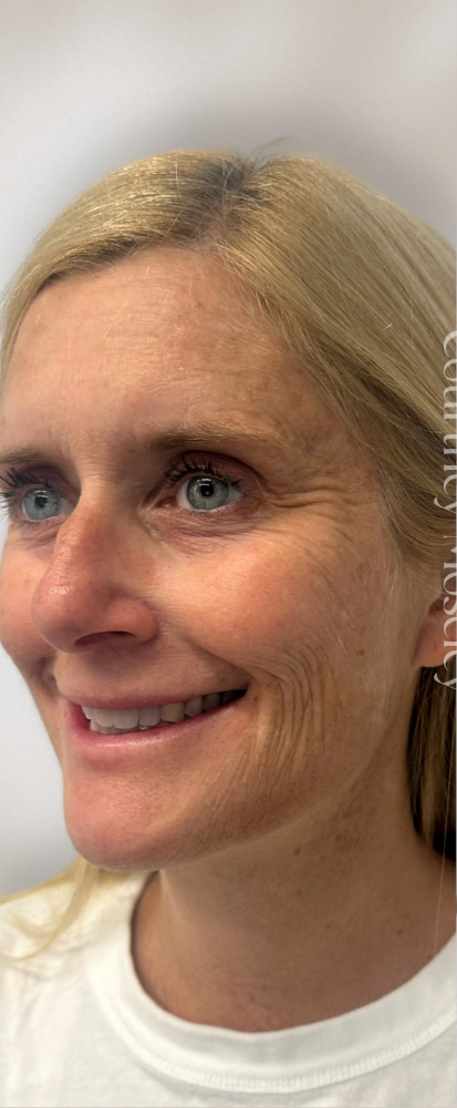 PRF Before & After Image