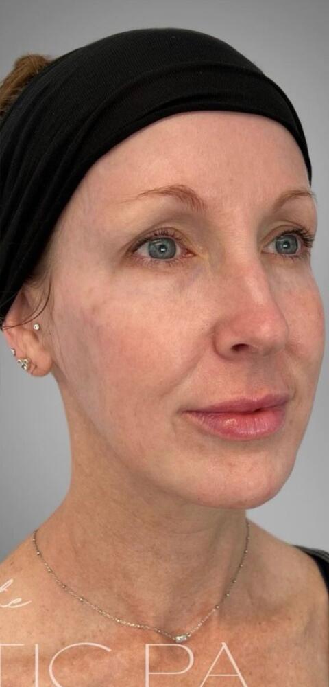 Sculptra Before & After Image