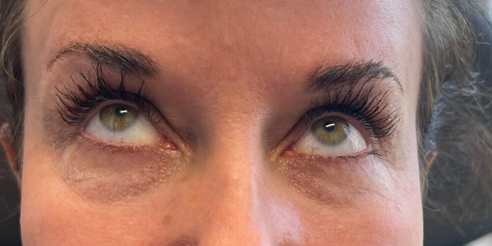 Under Eye Filler Before & After Image