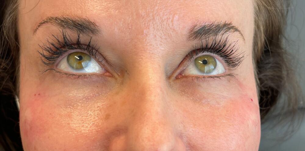 Under Eye Filler Before & After Image