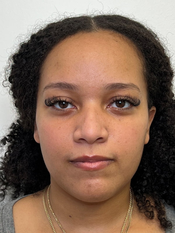 Under Eye Filler Before & After Image