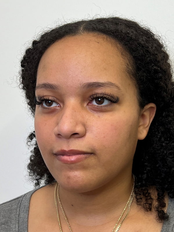 Under Eye Filler Before & After Image